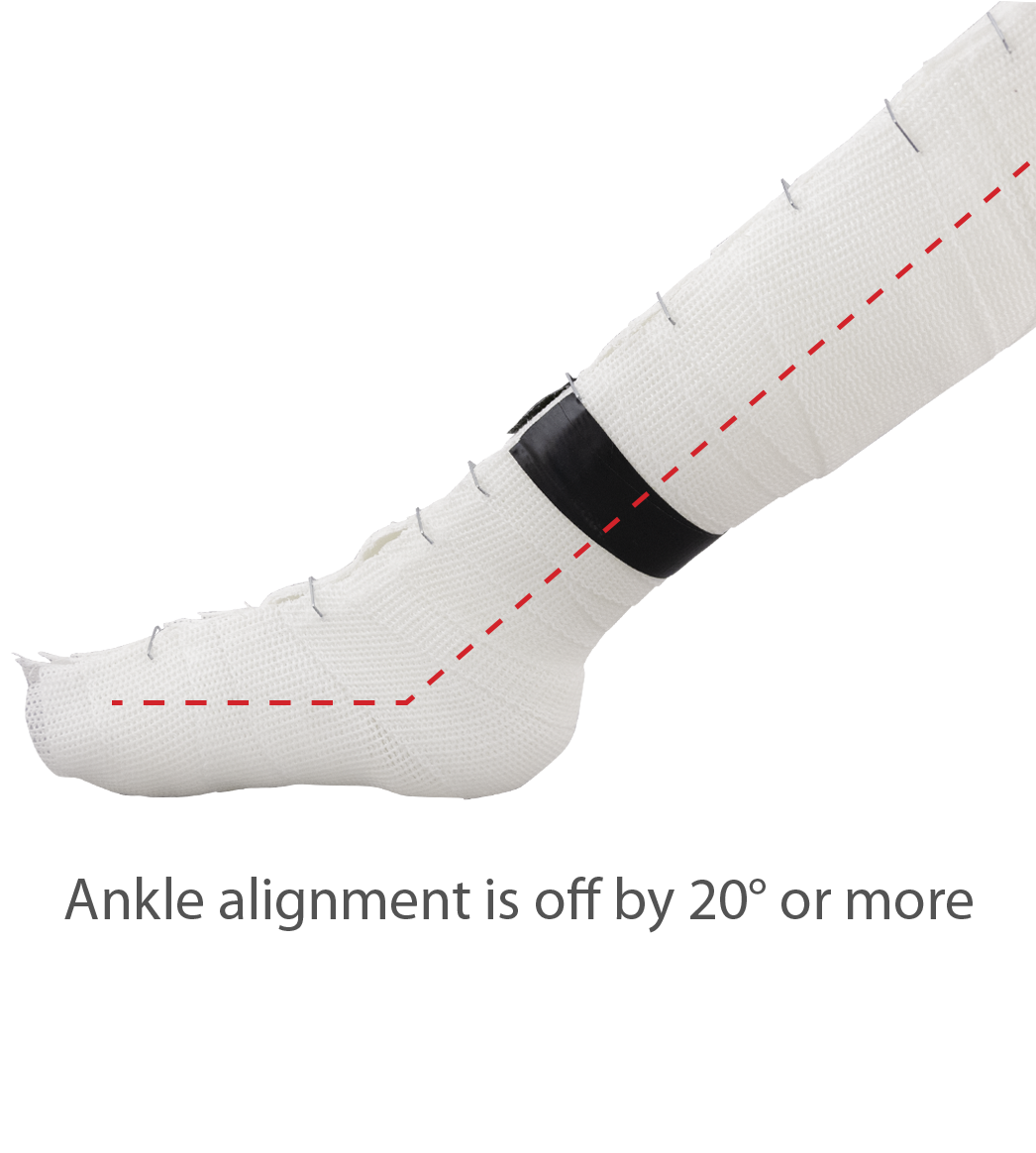 Ankle alignment is more