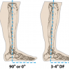 Ankle Alignment